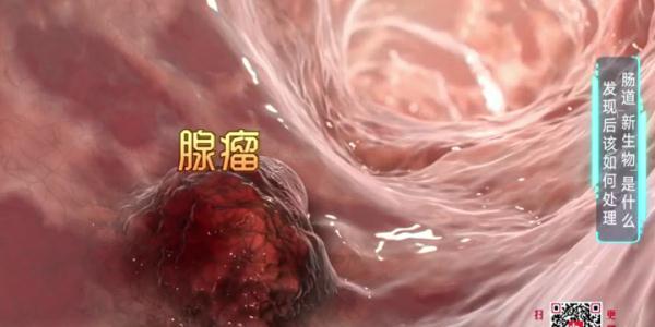 啥是肠道“新生物”?上完厕所你会回头看一眼吗?危险可能就在→ 啥是肠道“新生物”?上完厕所你会回头看一眼吗?危险可能就在→