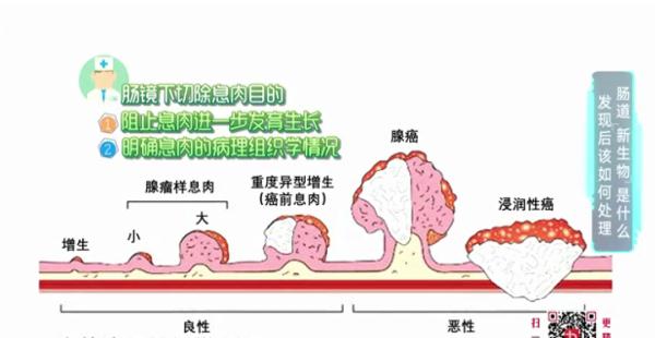 啥是肠道“新生物”?上完厕所你会回头看一眼吗?危险可能就在→ 啥是肠道“新生物”?上完厕所你会回头看一眼吗?危险可能就在→