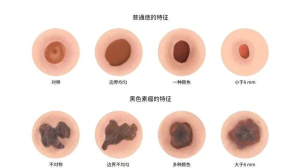 身上有这种黑痣，一定要警惕！有男歌手因它去世
