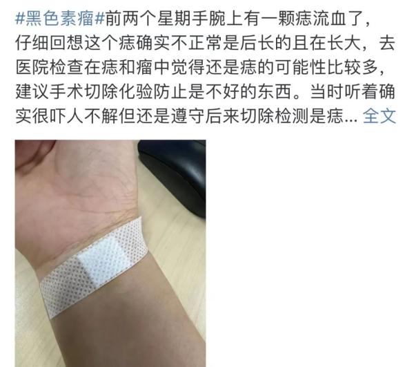 中国好声音亚军去世，年仅37岁！这种黑痣要当心