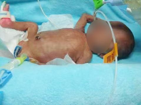 奇迹宝宝!“全国最轻”早产儿145天闯过重重生死关! 奇迹宝宝!“全国最轻”早产儿145天闯过重重生死关!