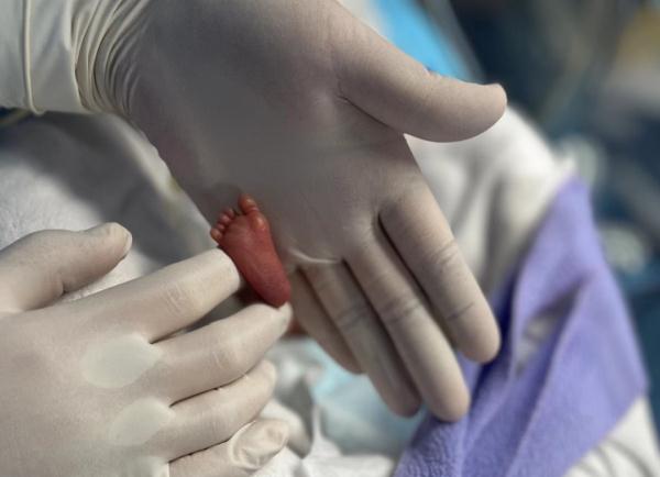 奇迹宝宝!“全国最轻”早产儿145天闯过重重生死关! 奇迹宝宝!“全国最轻”早产儿145天闯过重重生死关!