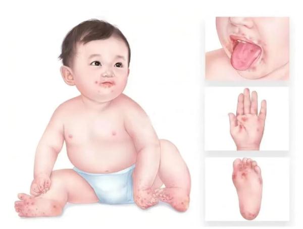 手足口病进入高发期,记住2种预防! 手足口病进入高发期,记住2种预防!