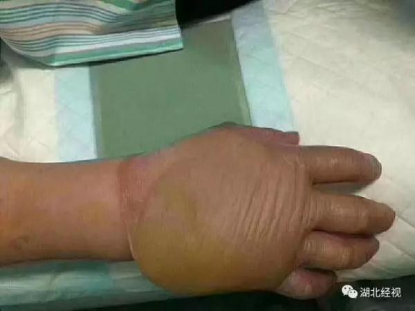 小孩玩氢气球瞬间爆燃,妈妈严重烧伤…… 小孩玩氢气球瞬间爆燃,妈妈严重烧伤……