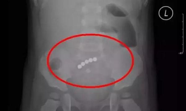 小孩玩氢气球瞬间爆燃,妈妈严重烧伤…… 小孩玩氢气球瞬间爆燃,妈妈严重烧伤……