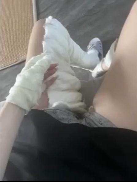 氢气球遇上吹风机爆炸，女子被大面积烧伤