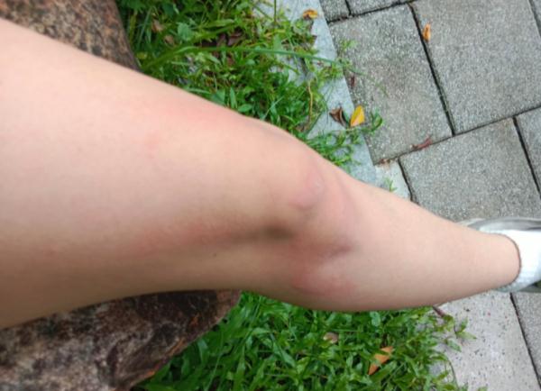 多处受伤！共享电动车刹车失灵，女子撞上路边围栏才停下