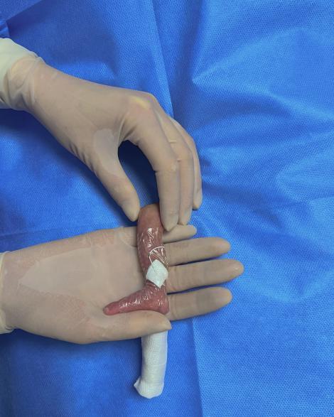 湖南胎龄最小的“巴掌宝宝”闯关132天后……