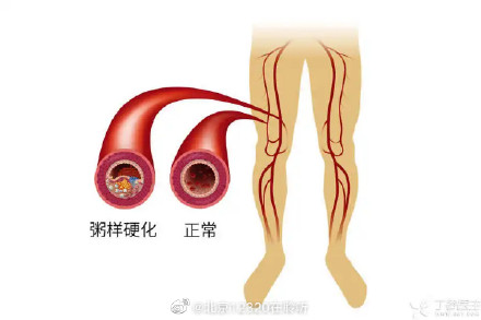 下肢动脉硬化闭塞症有什么症状？