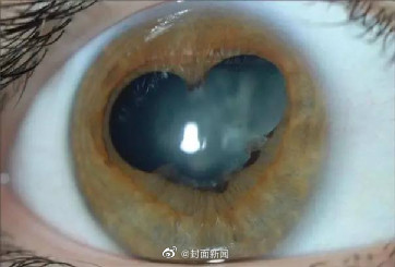 眼睛又红又痒后瞳孔变成三角形 医生:为虹膜角膜内皮综合征 眼睛又红又痒后瞳孔变成三角形 医生:为虹膜角膜内皮综合征