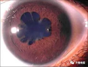 瞳孔突然变成三角形!医生紧急提醒→ 瞳孔突然变成三角形!医生紧急提醒→