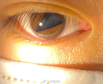 眼睛又红又痒后瞳孔变成三角形 医生:为虹膜角膜内皮综合征 眼睛又红又痒后瞳孔变成三角形 医生:为虹膜角膜内皮综合征