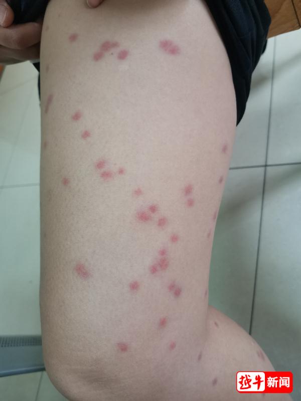 孩子腿上怎么那么多小红包？医生提醒家长……
