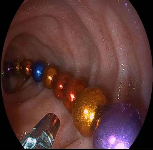 20个全吞了!医生紧急呼吁:千万别给孩子买这个! 20个全吞了!医生紧急呼吁:千万别给孩子买这个!