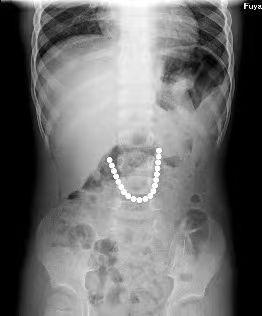 20个全吞了!医生紧急呼吁:千万别给孩子买这个! 20个全吞了!医生紧急呼吁:千万别给孩子买这个!