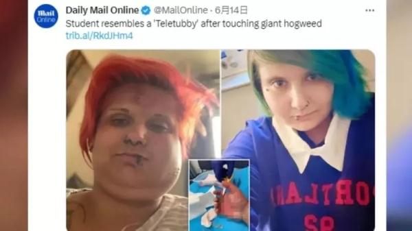 英国女子出门遛狗误触有毒植物 脸肿成“天线宝宝”