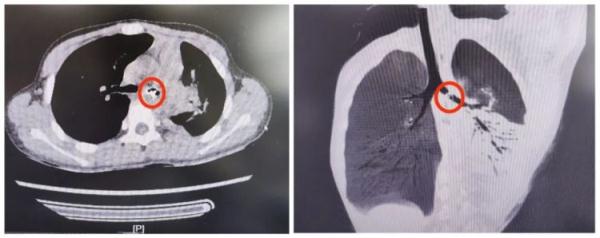 惊险！青岛一小学生咳嗽、发热8天，CT检查竟发现……