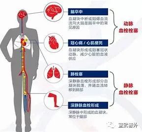 可怕的“经济舱综合征”可预防 可怕的“经济舱综合征”可预防