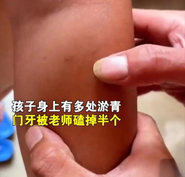 针扎虐待!刚刚,警方通报 针扎虐待!刚刚,警方通报