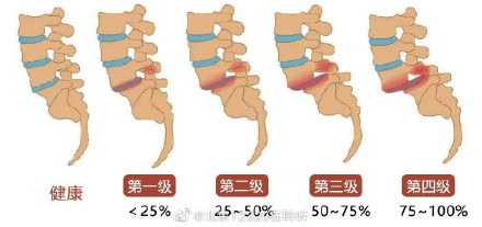 什么是腰椎滑脱? 什么是腰椎滑脱?