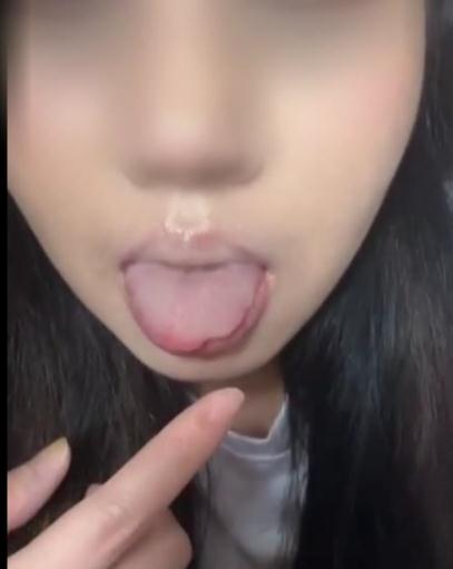 吃个菠萝，女子舌头被“腐蚀”缺了一块……