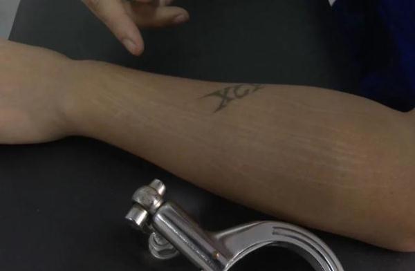 目睹“生割腰子”、手指险被砍断……缅北逃回男子自述