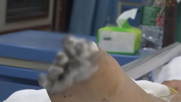 女孩充电玩手机遭电击，内脏受损面临截肢