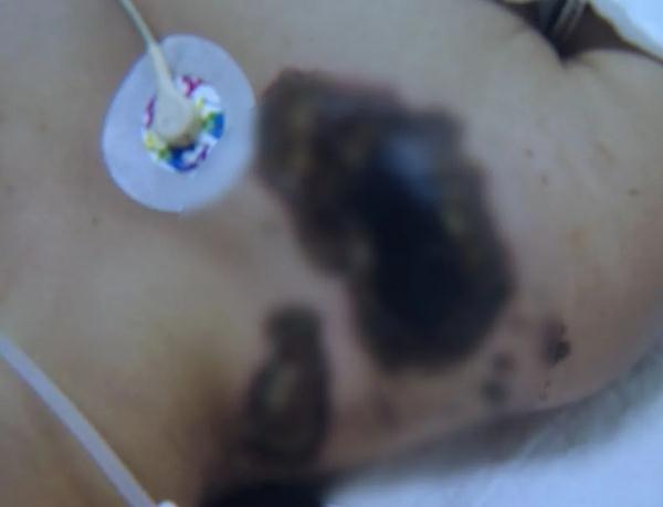 女孩充电玩手机遭电击，内脏受损面临截肢