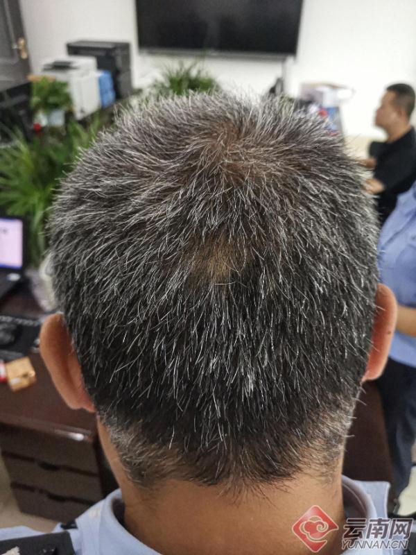 又一位！年仅40岁的他，已是满头白发