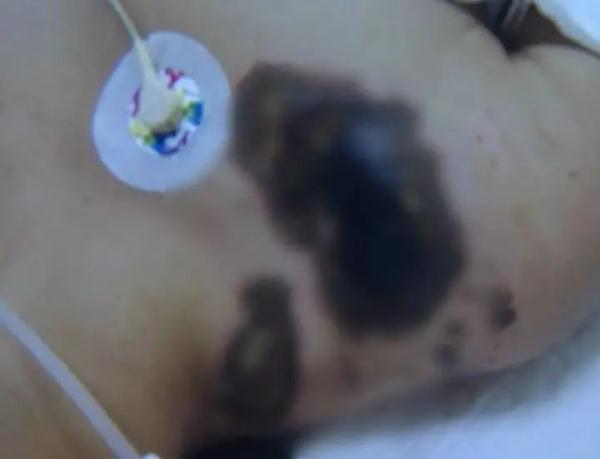 17岁女孩边充电边玩手机被电击，脚趾被烧焦面临截肢