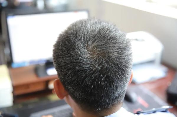 又一位！年仅40岁的他，已是满头白发