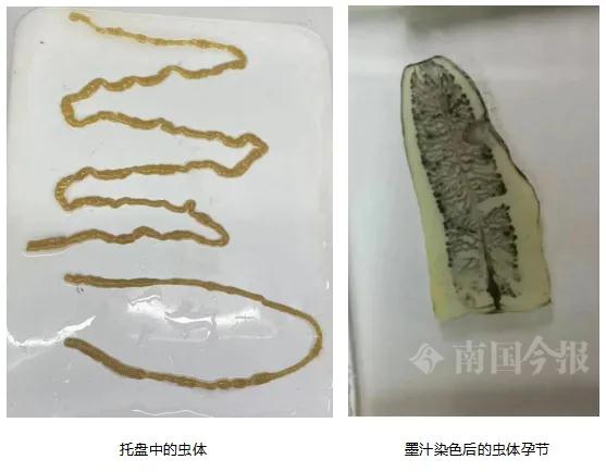 柳州男子排出一米长虫体!医生提醒:这种食物慎入口 柳州男子排出一米长虫体!医生提醒:这种食物慎入口
