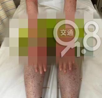 女子全身火龙果色！医生都说少见，竟是因为家里的...