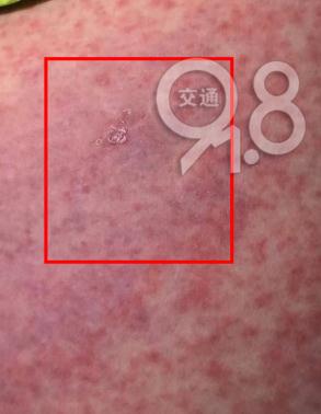 女子全身火龙果色！医生都说少见，竟是因为家里的...