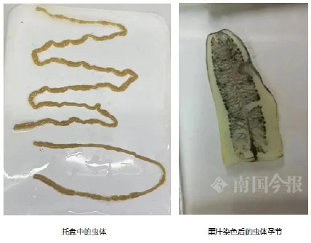 男子疑因吃下半熟牛杂感染绦虫病,排出一米长虫体 男子疑因吃下半熟牛杂感染绦虫病,排出一米长虫体