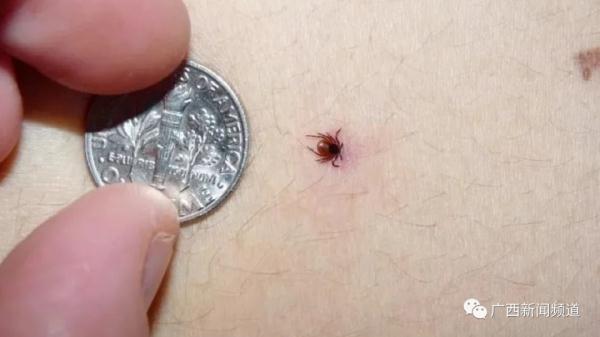 夏季高发！男子野外钓鱼感染恙虫病，高烧40度危及生命