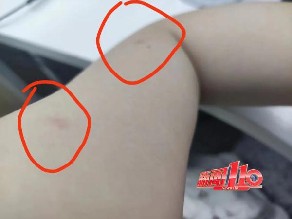 近期高发!出门一圈全身出现几十处!福州已有人因此“白肺”…… 近期高发!出门一圈全身出现几十处!福州已有人因此“白肺”……