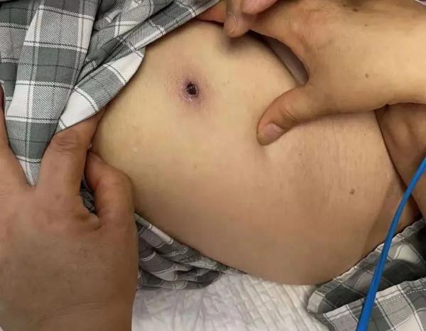 近期高发!出门一圈全身出现几十处!福州已有人因此“白肺”…… 近期高发!出门一圈全身出现几十处!福州已有人因此“白肺”……