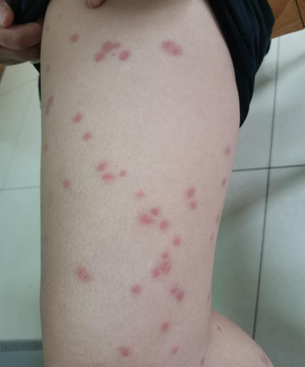 近期高发!出门一圈全身出现几十处!福州已有人因此“白肺”…… 近期高发!出门一圈全身出现几十处!福州已有人因此“白肺”……