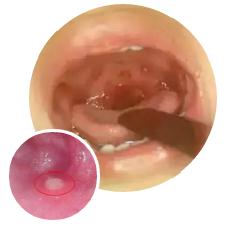 突然高烧,喉咙“长泡泡”......这种病近期高发,防护要点看这里! 突然高烧,喉咙“长泡泡”......这种病近期高发,防护要点看这里!