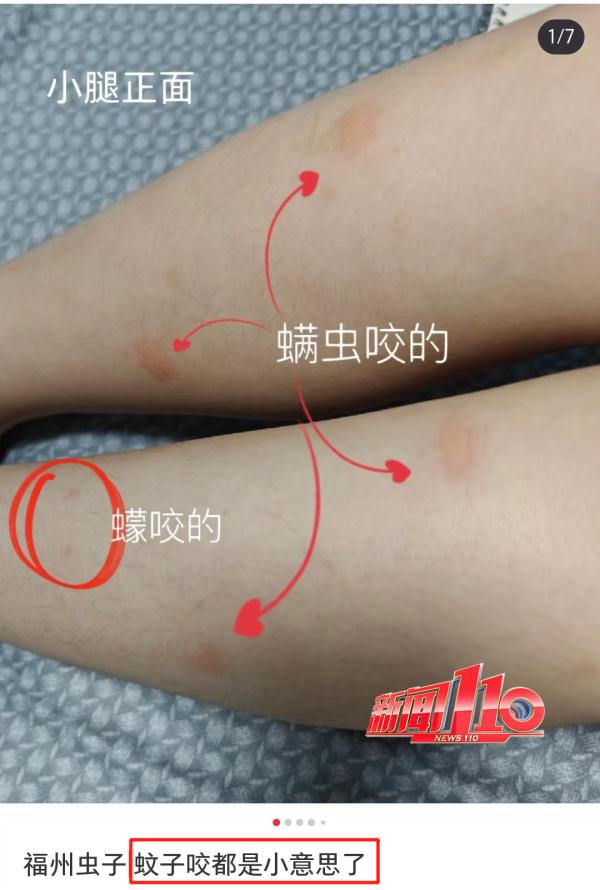 近期高发!出门一圈全身出现几十处!福州已有人因此“白肺”…… 近期高发!出门一圈全身出现几十处!福州已有人因此“白肺”……