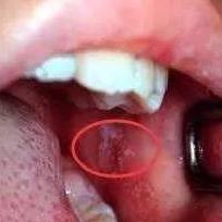 突然高烧,喉咙“长泡泡”......这种病近期高发,防护要点看这里! 突然高烧,喉咙“长泡泡”......这种病近期高发,防护要点看这里!