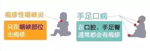 突然高烧,喉咙“长泡泡”......这种病近期高发,防护要点看这里! 突然高烧,喉咙“长泡泡”......这种病近期高发,防护要点看这里!