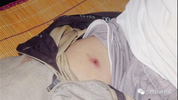 夏季高发！男子野外钓鱼感染恙虫病，高烧40度危及生命