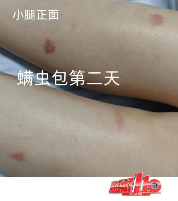 近期高发!出门一圈全身出现几十处!福州已有人因此“白肺”…… 近期高发!出门一圈全身出现几十处!福州已有人因此“白肺”……