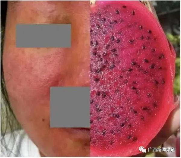 夏季高发！男子野外钓鱼感染恙虫病，高烧40度危及生命