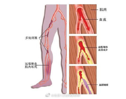 你知道什么是下肢动脉粥样硬化性疾病吗？
