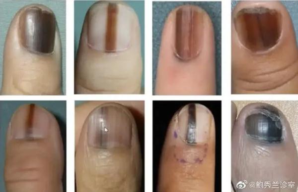 赶紧看自己的手！指甲上突然长了一条…上热搜！网友慌了