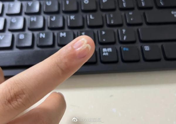 赶紧看自己的手！指甲上突然长了一条…上热搜！网友慌了