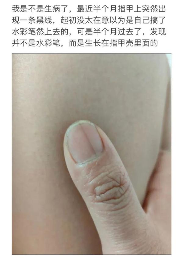 赶紧看自己的手！指甲上突然长了一条…上热搜！网友慌了